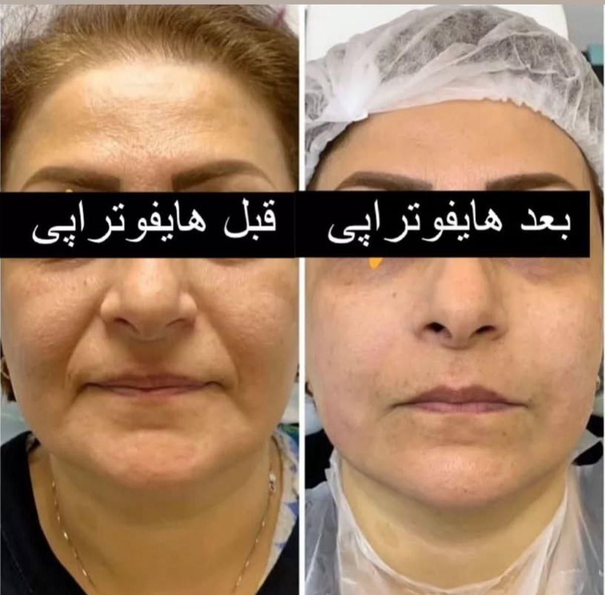 دو نفر مدل برای هایفوتراپی|خدمات آرایشگری و زیبایی|تهران, حکمت|دیوار