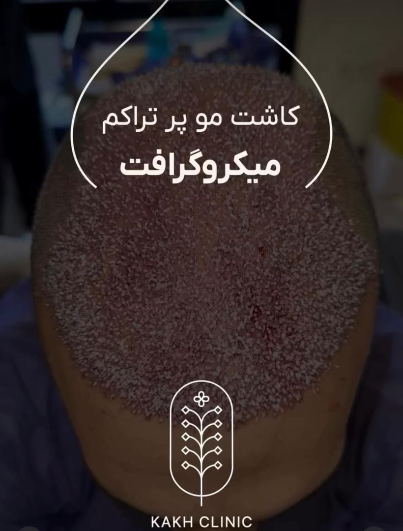 نیازمند مدل کاشت مو بدون پرداختی|خدمات آرایشگری و زیبایی|تهران, قلهک|دیوار