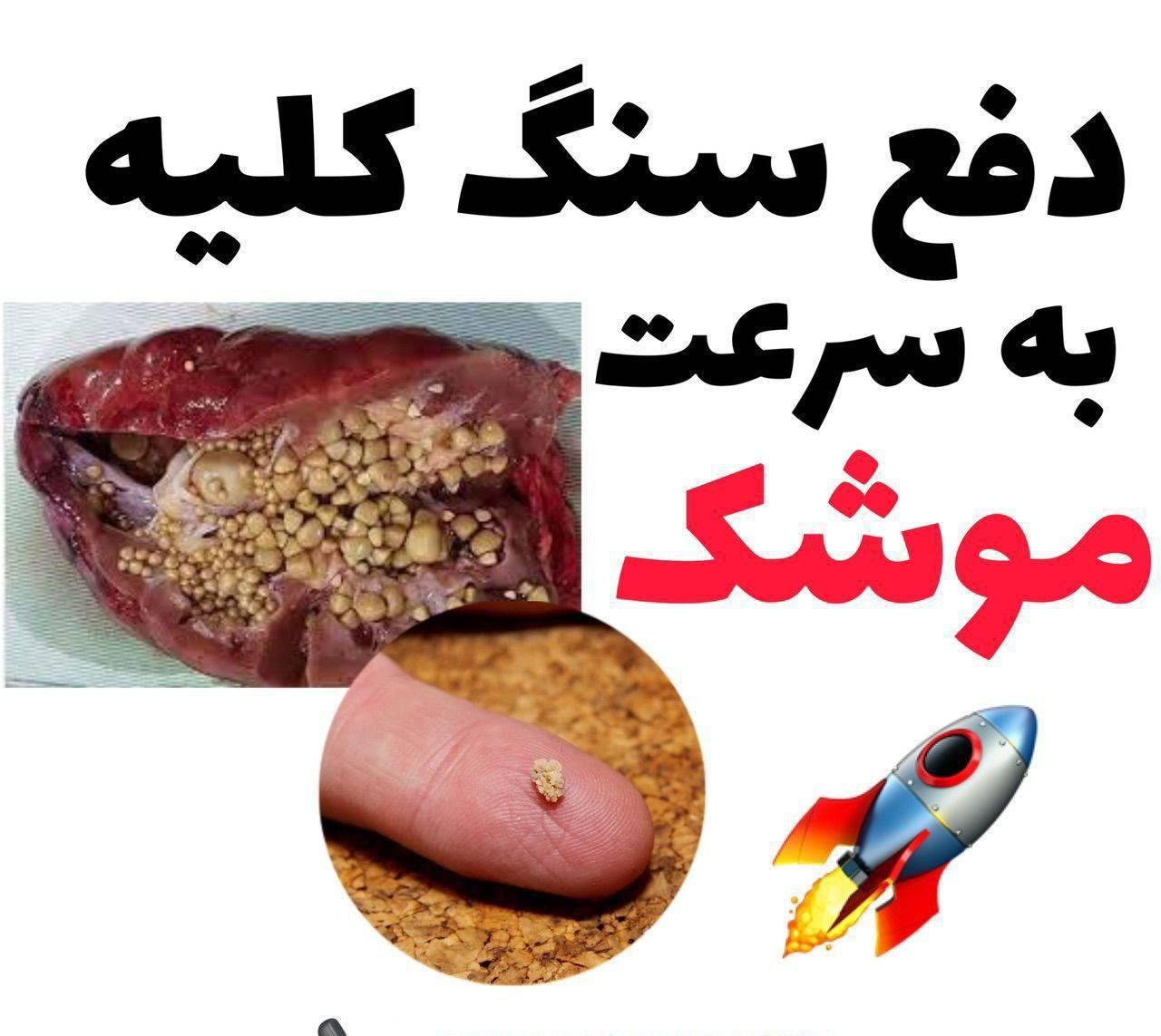 درمان کلیه سنگ ساز با ضمانت|خدمات آرایشگری و زیبایی|تهران, جمهوری|دیوار