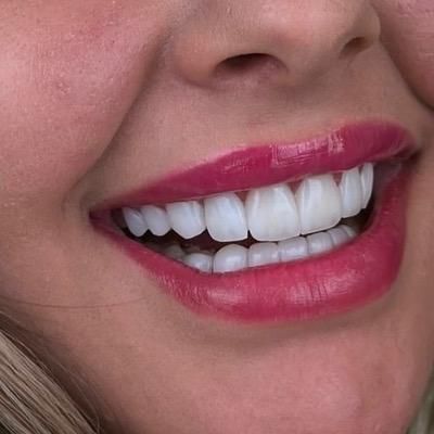خدمات زیبایی دندان لمینت کامپوزیت لیانا|خدمات آرایشگری و زیبایی|تهران, نارمک|دیوار