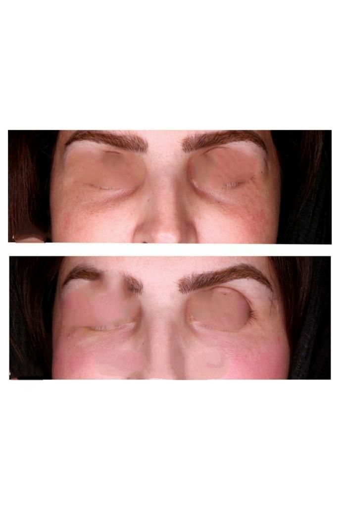 ژل زیرچشم شقیقه فیلر گودی چشم و شقیقه درمان گودی|خدمات آرایشگری و زیبایی|تهران, صادقیه|دیوار