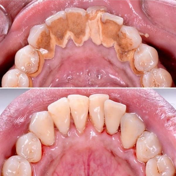 جرمگیری .سفید کردن دندان.روکش|خدمات آرایشگری و زیبایی|تهران, میرداماد|دیوار