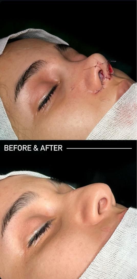 عمل جراحی بینی با دستگاه پیزو 22/لیفت صورت/پلک|خدمات آرایشگری و زیبایی|تهران, توانیر|دیوار