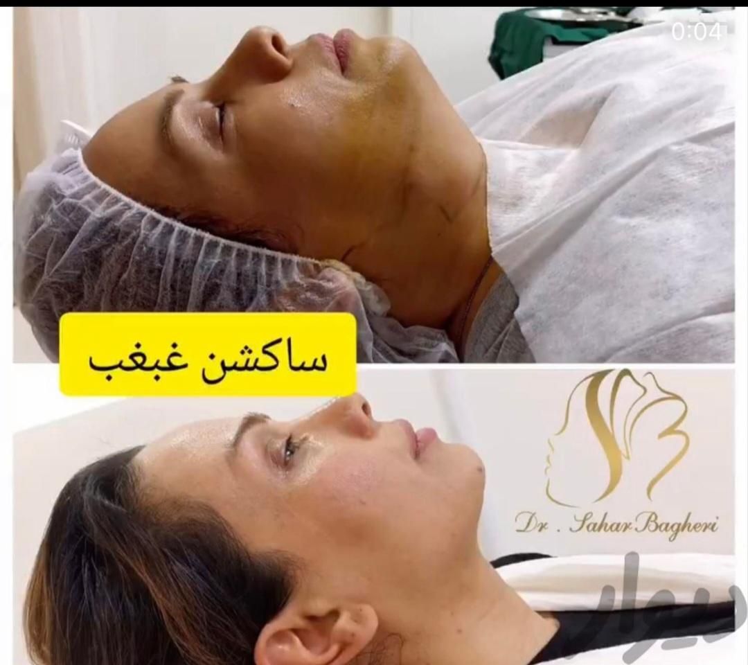 تزریق بوتاکس و ژل.جراحی بوکال فت|خدمات آرایشگری و زیبایی|تهران, صادقیه|دیوار