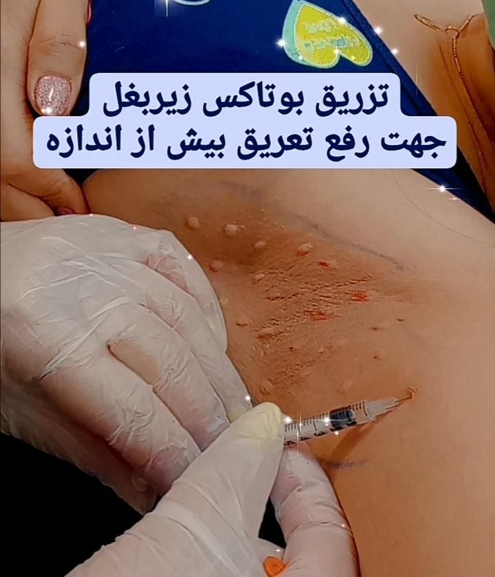 لیزر مو بوتاکس پی ار پی مزو ابرو هیرفیلردر پیروزی|خدمات آرایشگری و زیبایی|تهران, صد دستگاه|دیوار