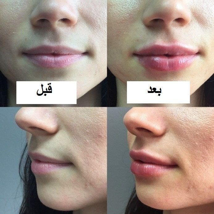 فیلر ژل لب چانه و بوتاکس پیشانی|خدمات آرایشگری و زیبایی|تهران, میرداماد|دیوار