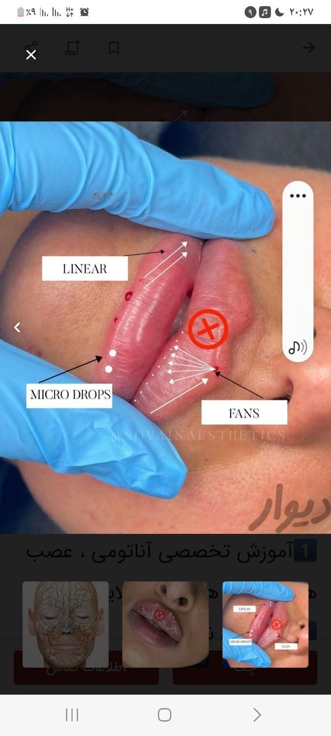 مدل ژل بوتاکس مزو امیریه|خدمات آرایشگری و زیبایی|تهران, امیریه|دیوار