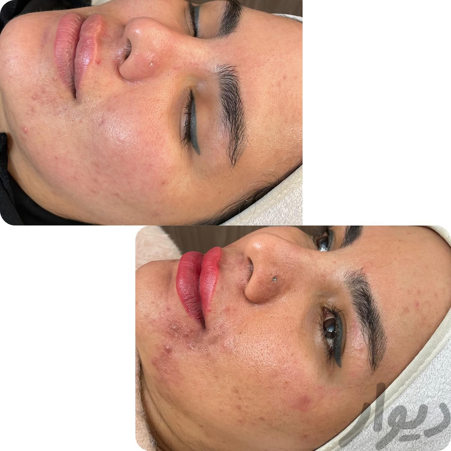 فشیال پوست(کلینیک پوست)|خدمات آرایشگری و زیبایی|مشهد, هاشمیه|دیوار