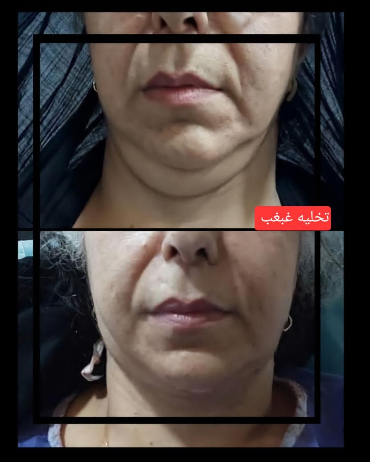 جشنواره تخلیه غبغب با تخفیف ویژه|خدمات آرایشگری و زیبایی|تهران, هاشمی|دیوار