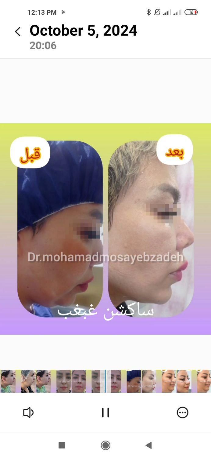 ساکشن تخصصی غبغب بهمراه کانتورینگ و تزریق چربی|خدمات آرایشگری و زیبایی|تهران, شهر زیبا|دیوار