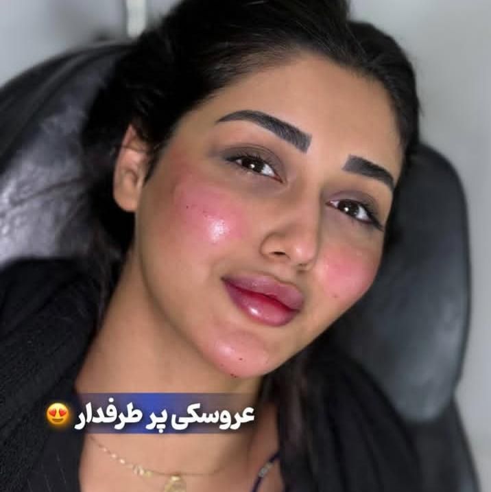 تزریق ژل و بوتاکس499|خدمات آرایشگری و زیبایی|تهران, عبدل‌آباد|دیوار