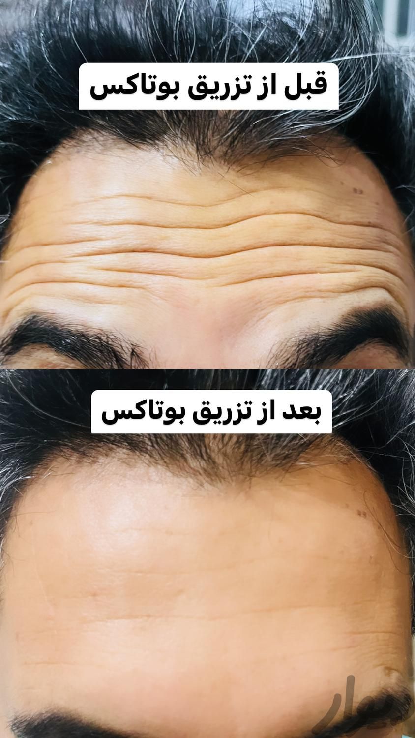 بوتاکس و فیلر و آنزیم و مزوتراپی مو و صورت|خدمات آرایشگری و زیبایی|شیراز, قدوسی غربی|دیوار