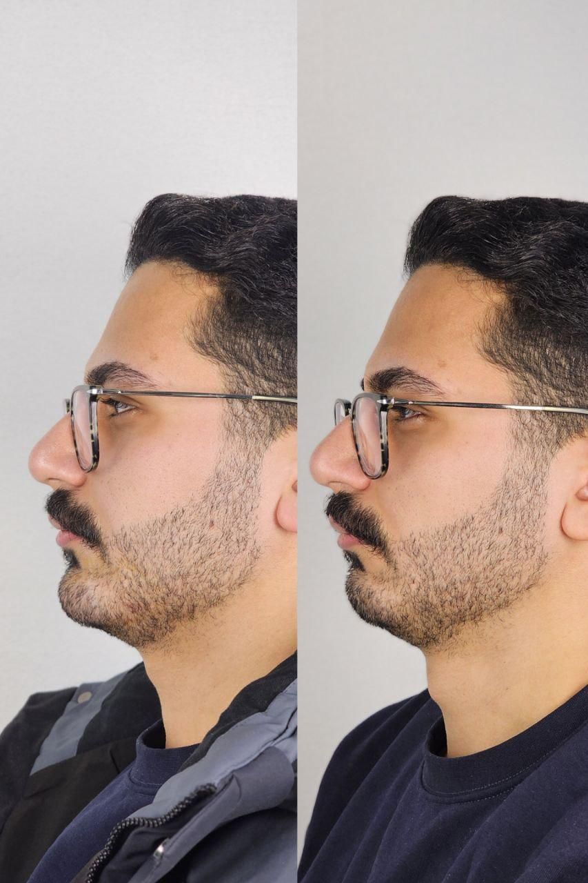 تزریق ژل  به صورت اقساطی بنا به شرایط خودتون|خدمات آرایشگری و زیبایی|تهران, یوسف‌آباد|دیوار