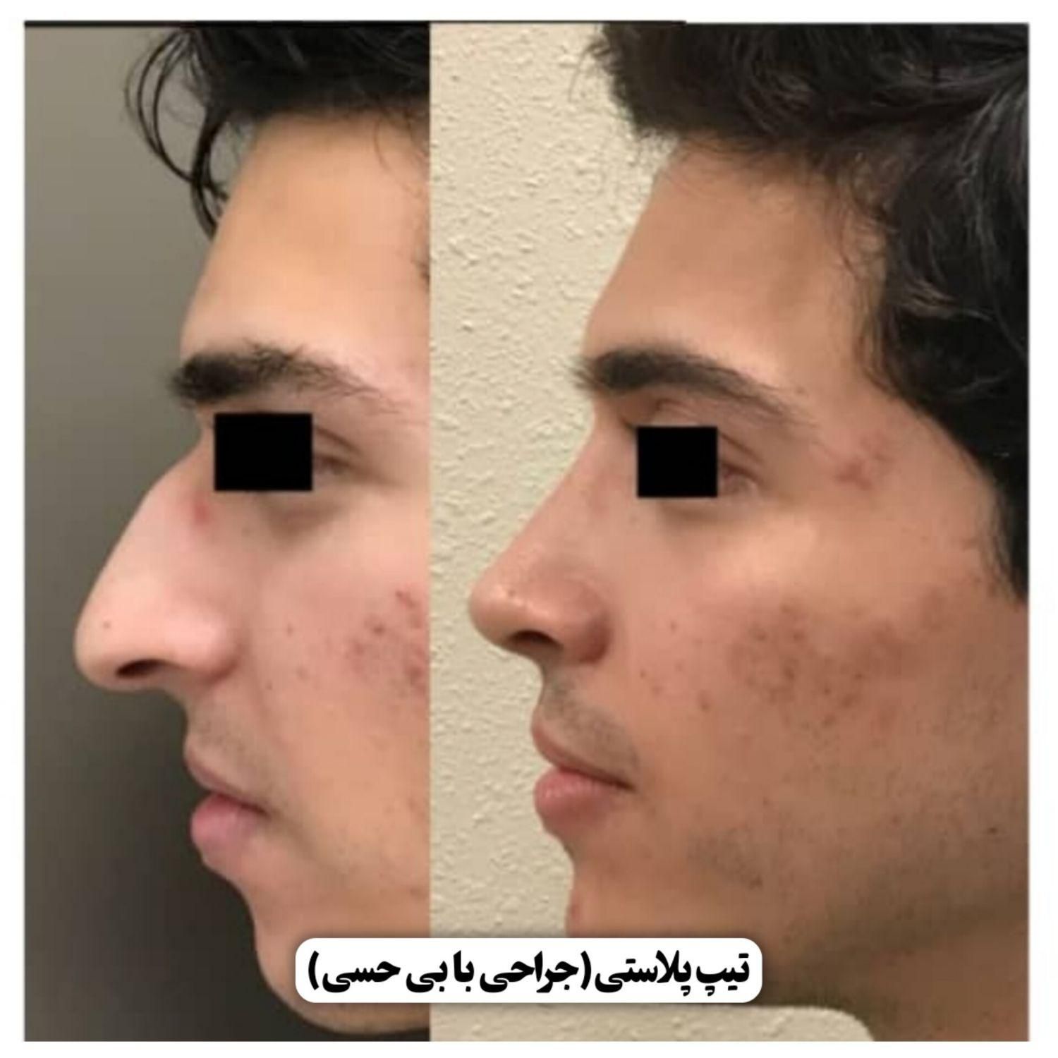 جراحی زیبایی بینی/رینوپلاستی|خدمات آرایشگری و زیبایی|تهران, آرژانتین|دیوار