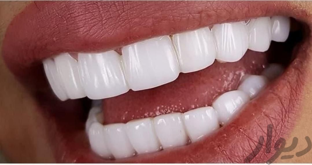پروتز دندان|استخدام درمانی، زیبایی و بهداشتی|ایذه, |دیوار