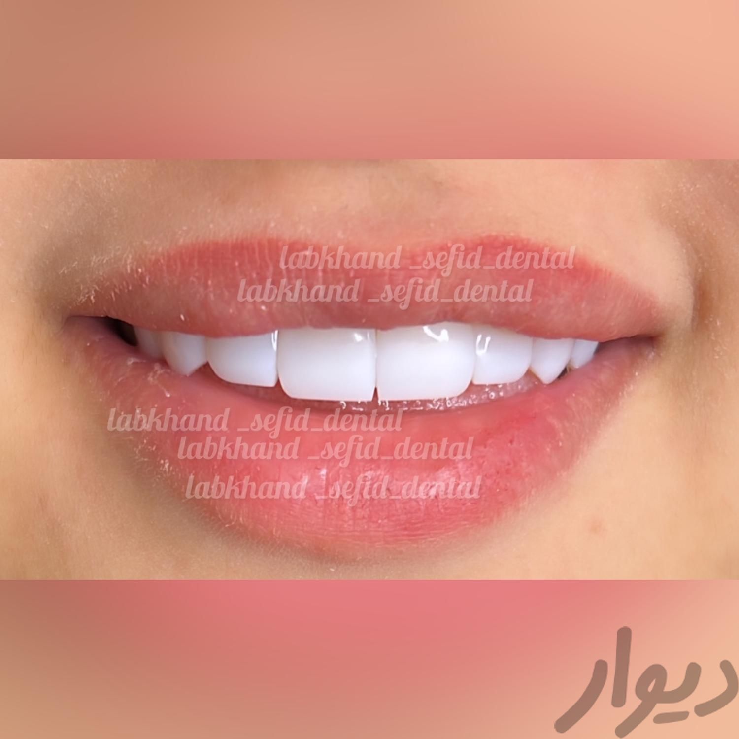 کامپوزیت دندان ،بریج دندان،بلیچینگ دندان|خدمات آرایشگری و زیبایی|اصفهان, شیخ صدوق|دیوار