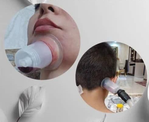 حجامت، زالودرمانی، سم‌زدایی از پا، بادکش|خدمات آرایشگری و زیبایی|تهران, مسعودیه|دیوار