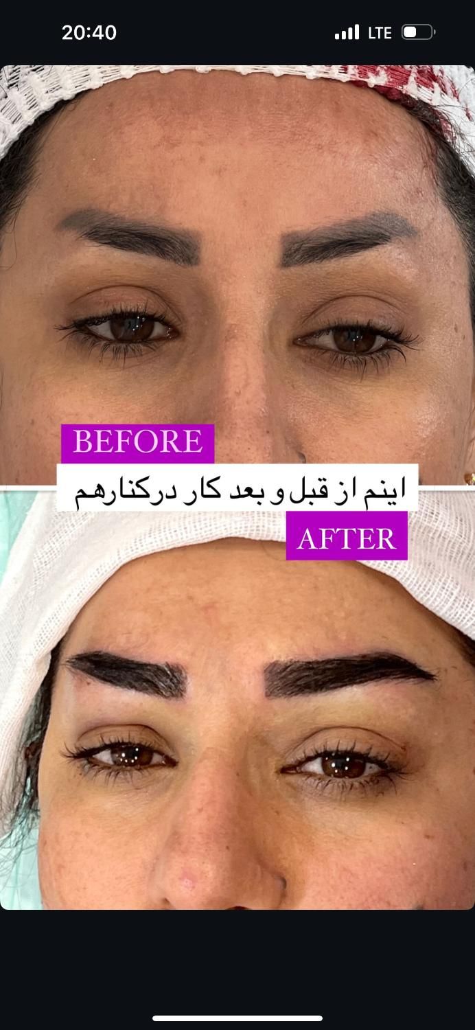 کاشت ابرو پر تراکم با خواب طبیعی|خدمات آرایشگری و زیبایی|تهران, میدان انقلاب|دیوار