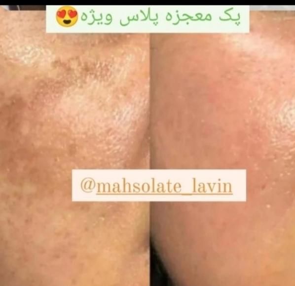 آموزش تخصصی کرم ضدلک وجوش|خدمات آموزشی|بوکان, |دیوار