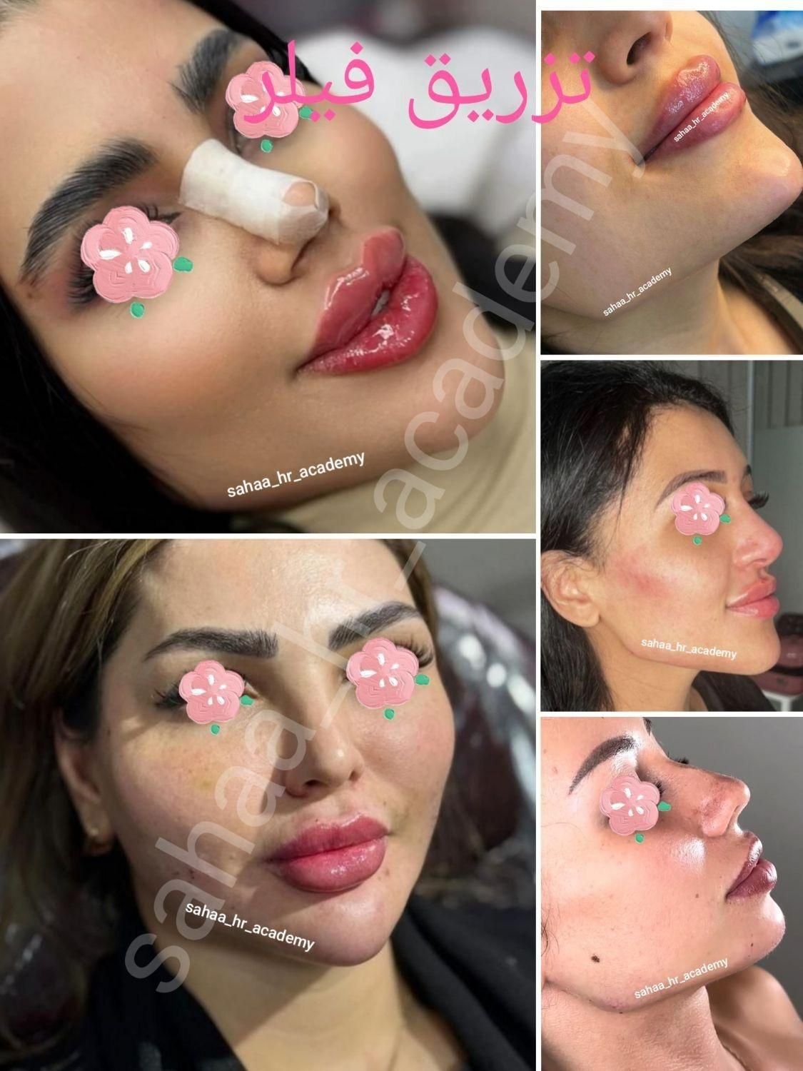 تزریق ژل بوتاکس چربی انزیم فیلر نخ پلکسر پلاسما|خدمات آرایشگری و زیبایی|مرودشت, ثبت احوال|دیوار