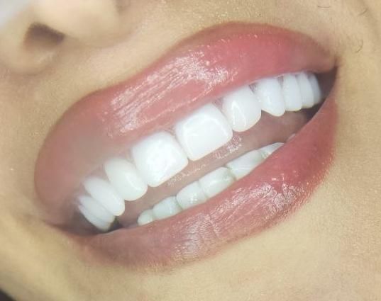دندان مصنوعی لمینتی .اقساط|خدمات آرایشگری و زیبایی|تهران, نواب|دیوار