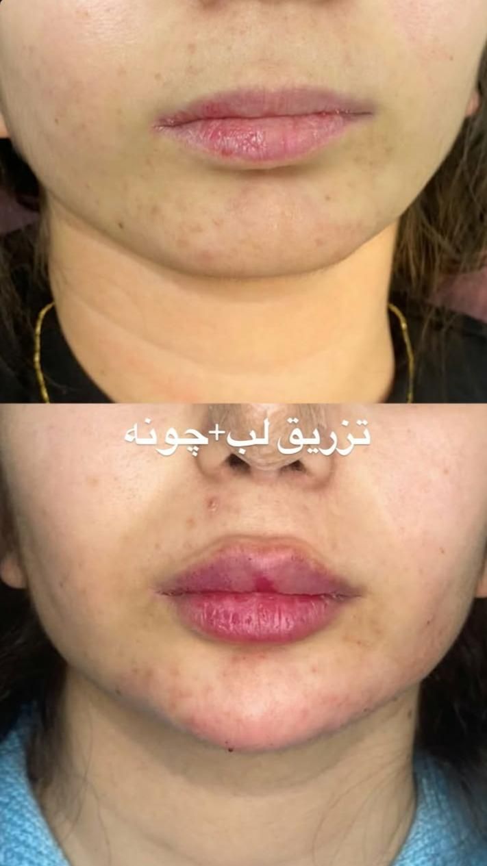 تزریق ژل و بوتاکس499|خدمات آرایشگری و زیبایی|تهران, عبدل‌آباد|دیوار
