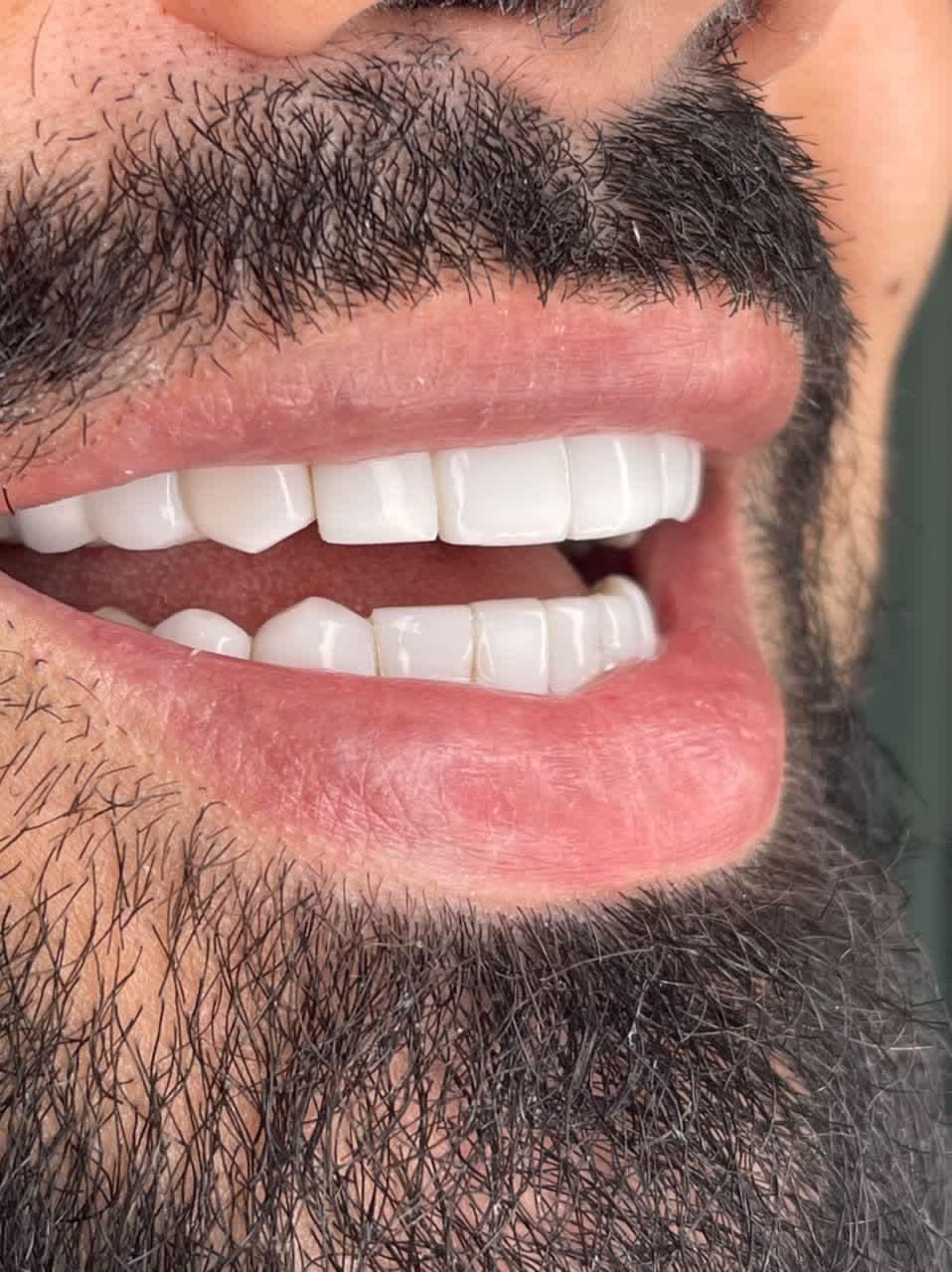 کامپوزیت دندان ارتودنسی ایمپلنت لمینت عصب کشی|خدمات آرایشگری و زیبایی|تهران, میدان ولیعصر|دیوار