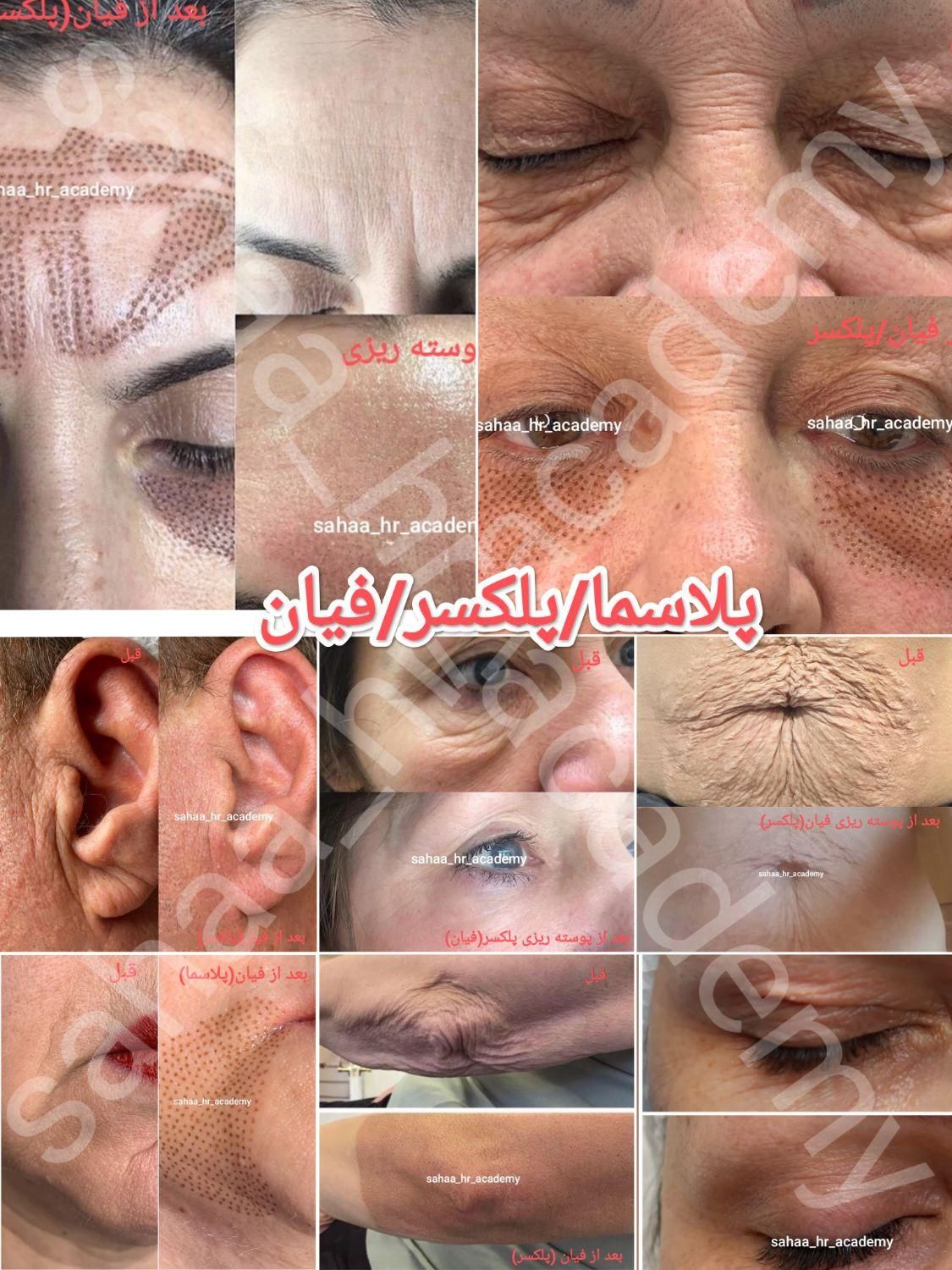 تزریق ژل بوتاکس چربی انزیم فیلر نخ پلکسر پلاسما|خدمات آرایشگری و زیبایی|مرودشت, ثبت احوال|دیوار