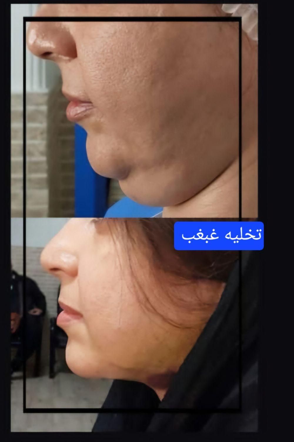 جشنواره تخلیه غبغب با تخفیف ویژه|خدمات آرایشگری و زیبایی|تهران, هاشمی|دیوار
