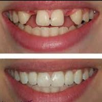 دندان مصنوعی پروتز دندانساز|خدمات آرایشگری و زیبایی|مشهد, پورسینا|دیوار