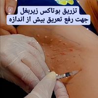 لیزر مو بوتاکس پی ار پی مزو ابرو هیرفیلردر پیروزی|خدمات آرایشگری و زیبایی|تهران, صد دستگاه|دیوار