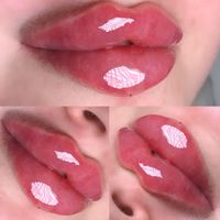 ژل لب فیلر لبروسی بوتاکس مزو جوانساز ژل گونه زاویه|خدمات آرایشگری و زیبایی|کرج, گوهردشت|دیوار