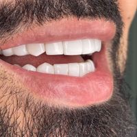 کامپوزیت دندان ارتودنسی ایمپلنت لمینت عصب کشی|خدمات آرایشگری و زیبایی|تهران, میدان ولیعصر|دیوار