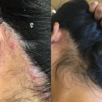 درمان قطعی و بدون بازگشت مشکلات پوستی|خدمات آرایشگری و زیبایی|کرمانشاه, |دیوار