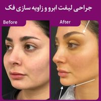 جراحی عمل بینی لیفت لیپوماتیک پروتزپیکرتراشی ژنیکو|خدمات آرایشگری و زیبایی|تهران, میدان ولیعصر|دیوار