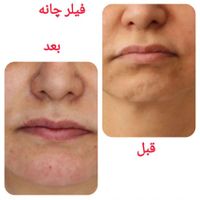 ژل بوتاکس مزوتراپی/آموزش/زیبایی/لاغری|خدمات آرایشگری و زیبایی|تهران, تهرانپارس شرقی|دیوار