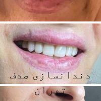 دندان مصنوعی لمینتی .اقساط|خدمات آرایشگری و زیبایی|تهران, نواب|دیوار