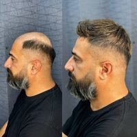 پروتزموترمیم مو پرپشتی مو در1جلسه|خدمات آرایشگری و زیبایی|اصفهان, نقش جهان|دیوار