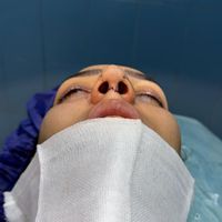 عمل بینی جراحی بینی|خدمات آرایشگری و زیبایی|تهران, شهرک غرب|دیوار