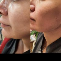 جشنواره مرکز تزریق چربی صورت ،ژل ،بوتاکس.prp|خدمات آرایشگری و زیبایی|کرج, اصفهانی‌ها|دیوار