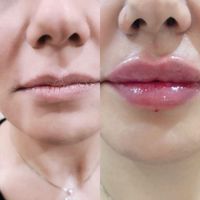 جشنواره مرکز تزریق چربی صورت ،ژل ،بوتاکس.prp|خدمات آرایشگری و زیبایی|کرج, اصفهانی‌ها|دیوار