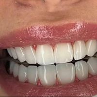مدل کامپوزیت ونیر به مدت یک هفته|خدمات آرایشگری و زیبایی|تهران, جنت‌آباد جنوبی|دیوار