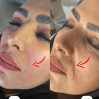 تزریق ژل و بوتاکس499|خدمات آرایشگری و زیبایی|تهران, عبدل‌آباد|دیوار