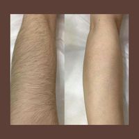 مرکز تخصصی لیزر موهای زائد بادستگاه فوق پیشرفته|خدمات آرایشگری و زیبایی|آبادان, |دیوار