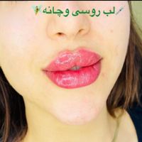 بوتاکس،ژل لب،زاویه،مزو مو،فیلربینی|خدمات آرایشگری و زیبایی|تهران, شهران شمالی|دیوار