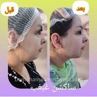 ساکشن تخصصی غبغب بهمراه کانتورینگ و تزریق چربی|خدمات آرایشگری و زیبایی|تهران, شهر زیبا|دیوار