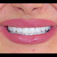 دست دندان مصنوعی طرح لمینیت|خدمات آرایشگری و زیبایی|تهران, تهرانپارس غربی|دیوار