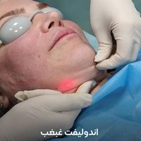 اندولیفت/هایفو/جوانسازی قوی/رفع سلولیت|خدمات آرایشگری و زیبایی|تهران, صادقیه|دیوار