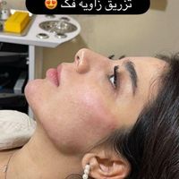 تزریق حرفه ای ژل و بوتاکس زاویه فک و فیلر بدن|خدمات آرایشگری و زیبایی|تهران, ستارخان|دیوار