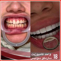 پالیش/ کشیدن دندان/لمینیت/ کامپوزیت در1جلسه/ روکش|خدمات آرایشگری و زیبایی|تهران, تهرانپارس غربی|دیوار